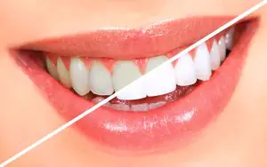 Clareamento dental — OrthoCorrect
