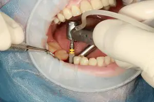 Implantes dentários — OrthoCorrect