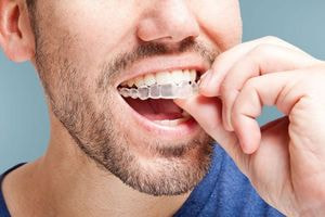 Invisalign