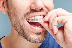 Alinhadores transparentes (Invisalign) — OrthoCorrect